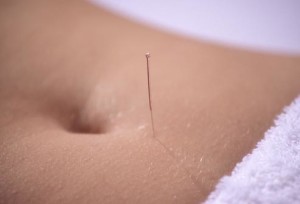 photolibrary_rm_photo_of_acupuncture_on_stomach